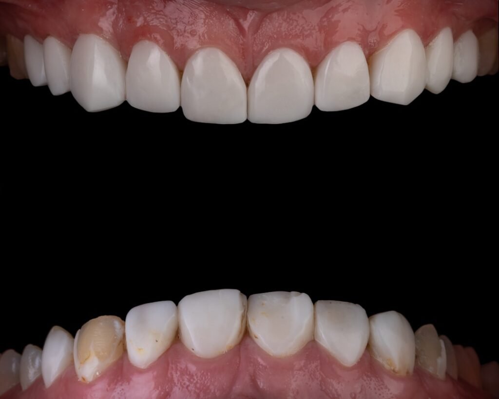 Close-up macro de faceta de porcelana dental